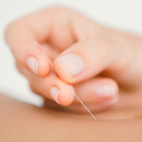 Acupuncture